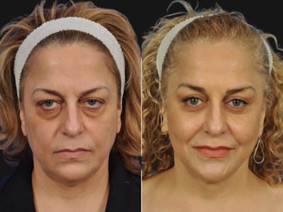Mid Facelift Before & After Gallery - Patient 197781 - Image 1