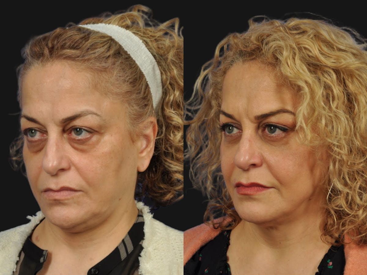Mid Facelift Before & After Gallery - Patient 197781 - Image 2