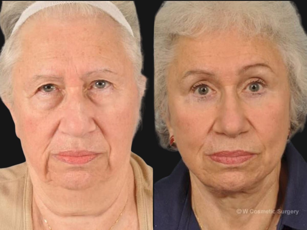 Mid Facelift Before & After Gallery - Patient 654797 - Image 2