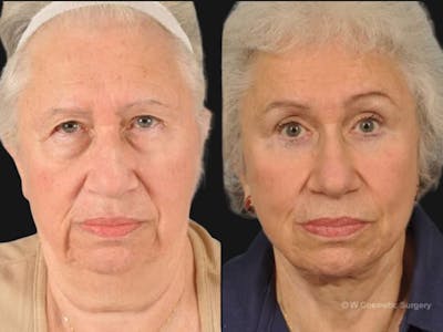 Mid Facelift Before & After Gallery - Patient 654797 - Image 2