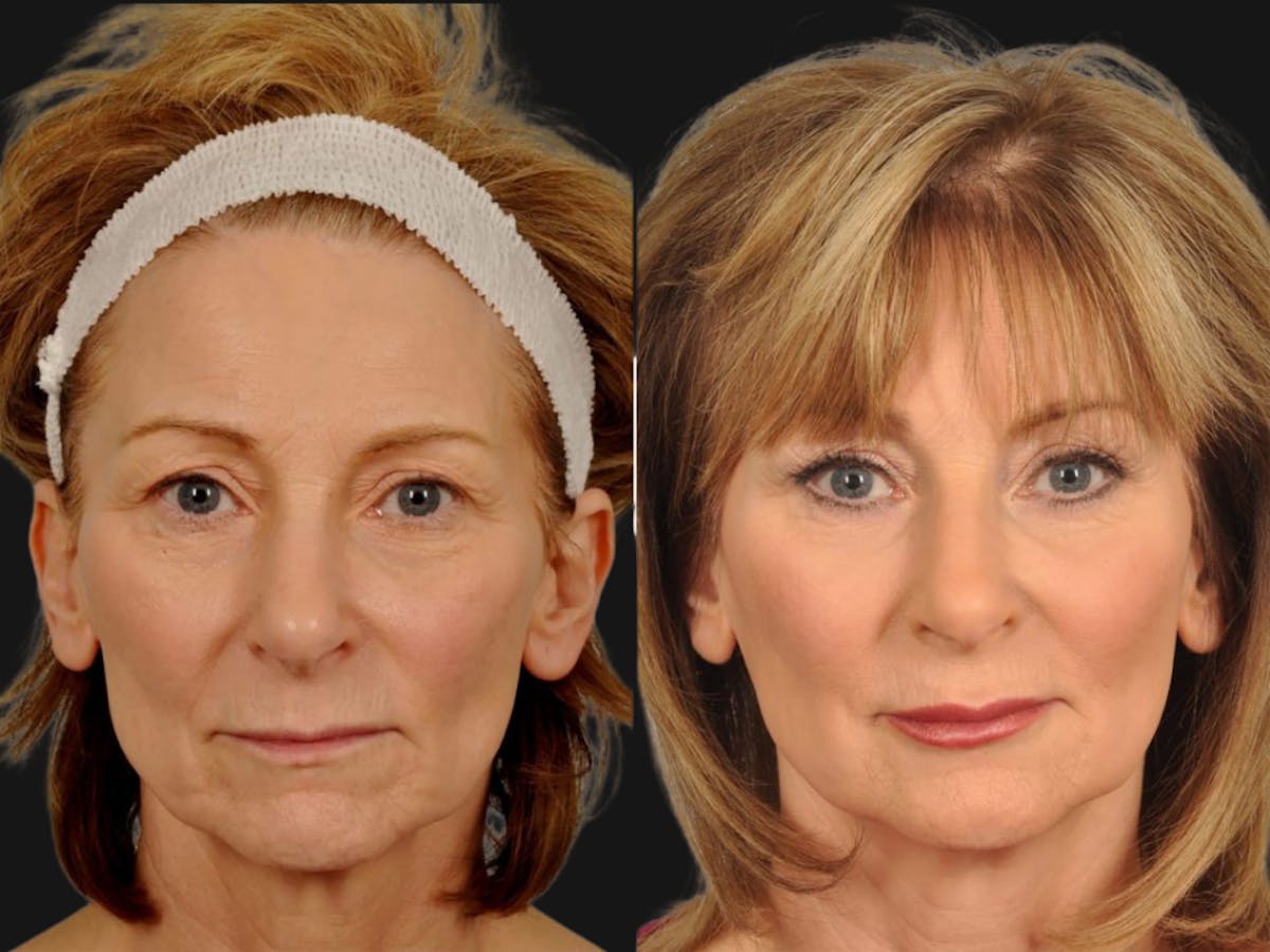 Mid Facelift Before & After Gallery - Patient 826650 - Image 1