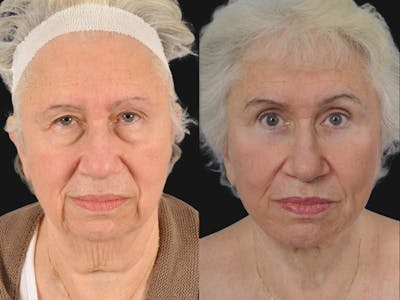 Mid Facelift Before & After Gallery - Patient 654797 - Image 1