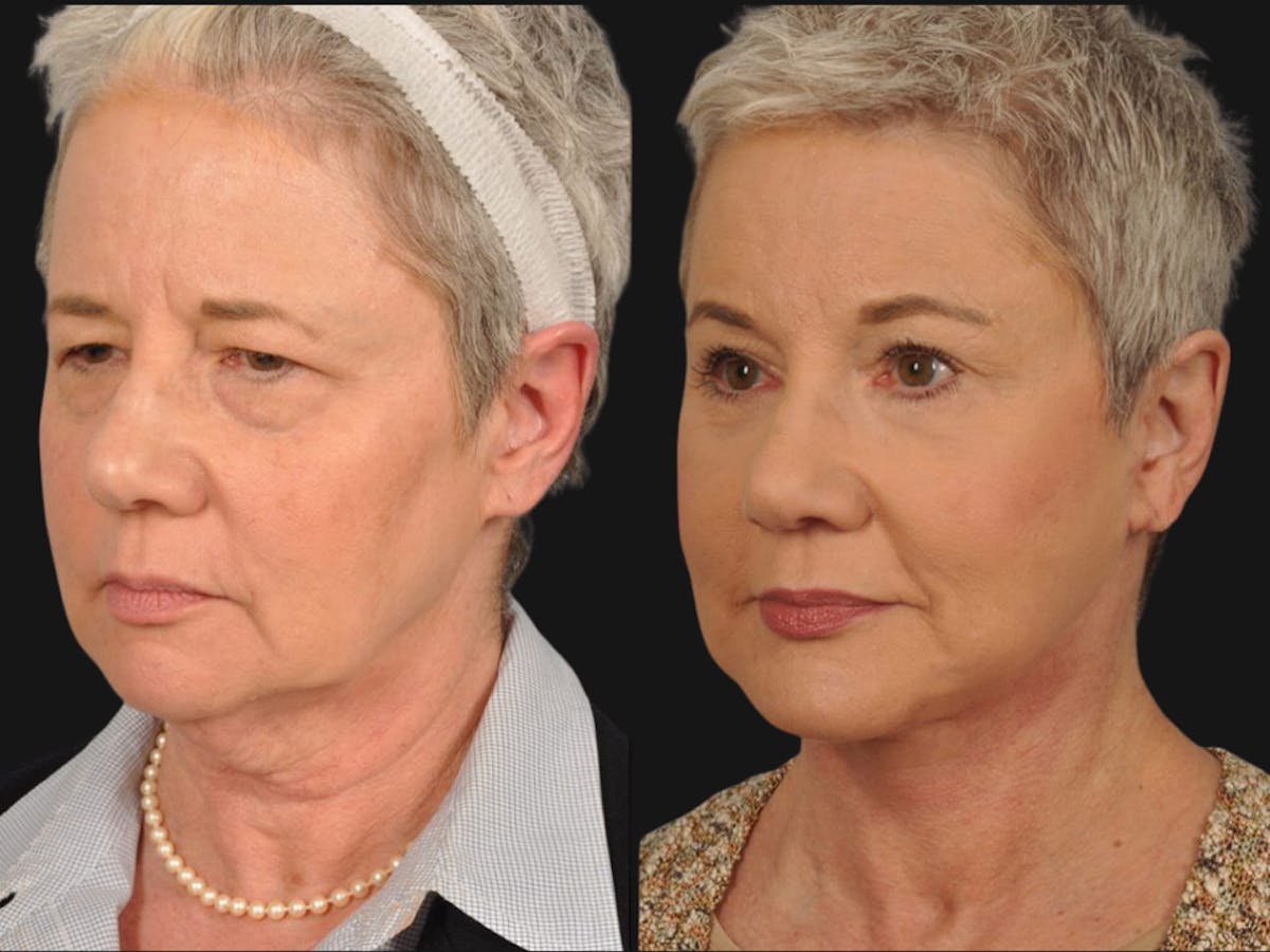 Mid Facelift Before & After Gallery - Patient 353250 - Image 3