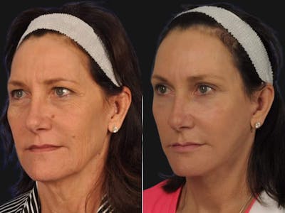 Mid Facelift Before & After Gallery - Patient 323593 - Image 3