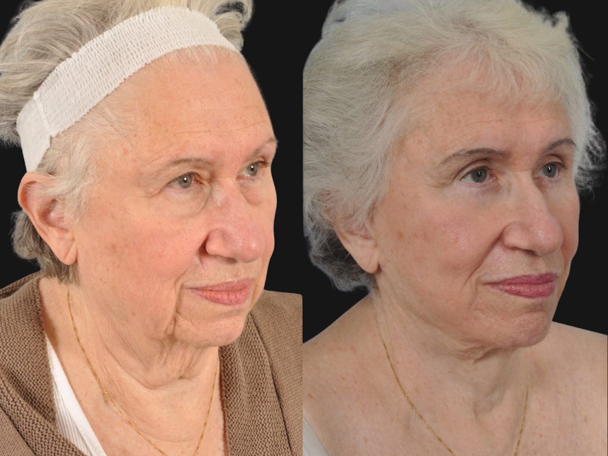 Mid Facelift Before & After Gallery - Patient 654797 - Image 3