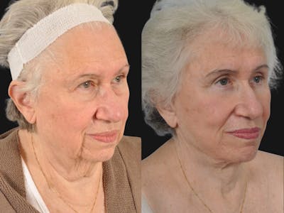 Mid Facelift Before & After Gallery - Patient 654797 - Image 3