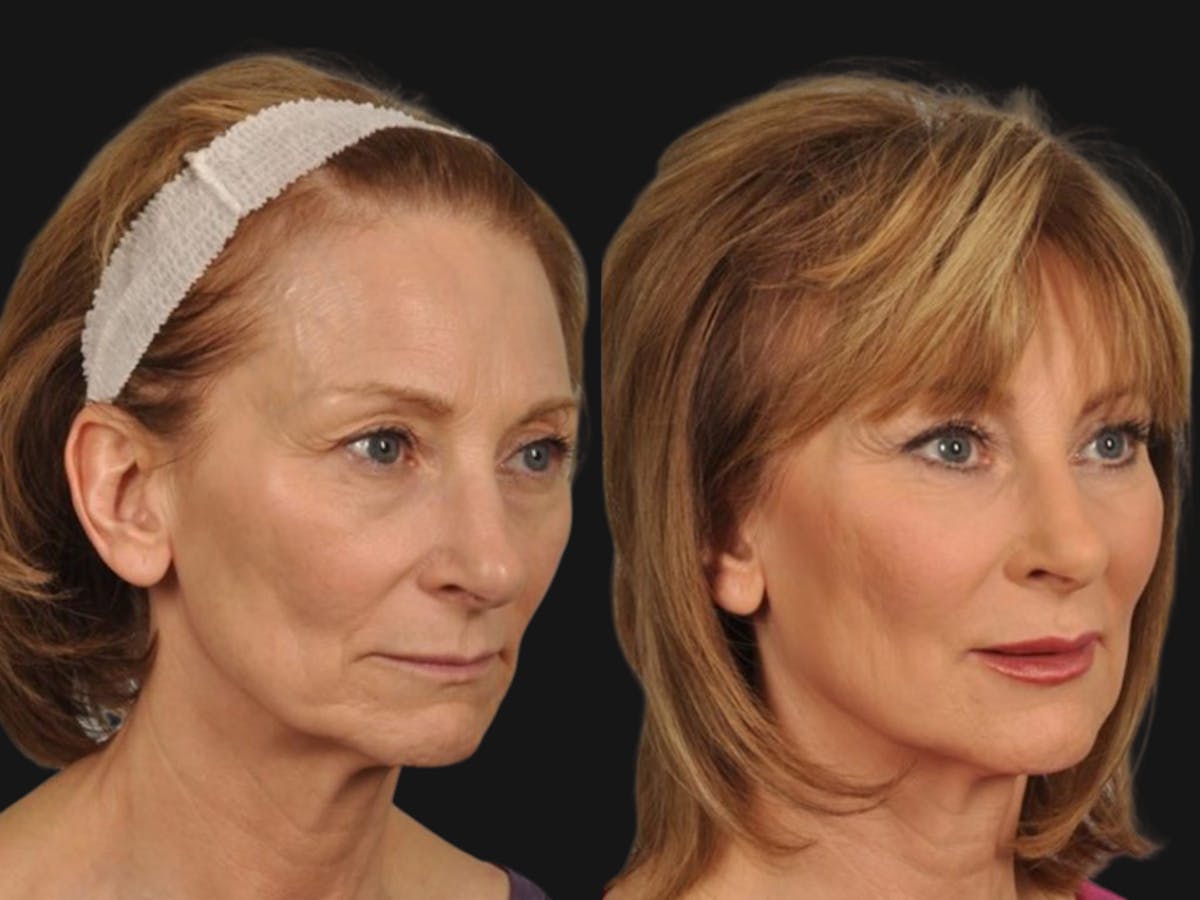 Mid Facelift Before & After Gallery - Patient 826650 - Image 3