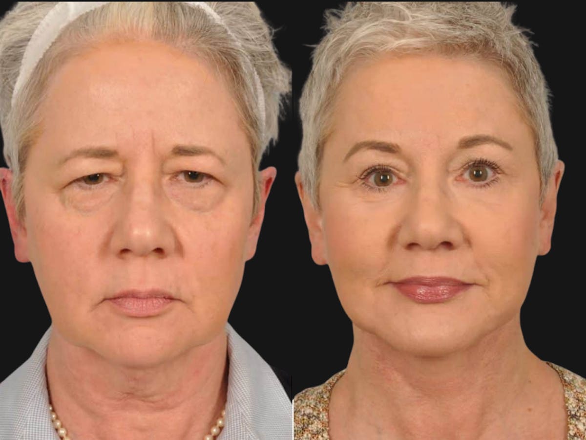 Mid Facelift Before & After Gallery - Patient 353250 - Image 1