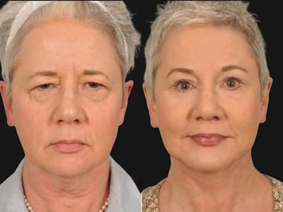 Mid Facelift Before & After Gallery - Patient 353250 - Image 1