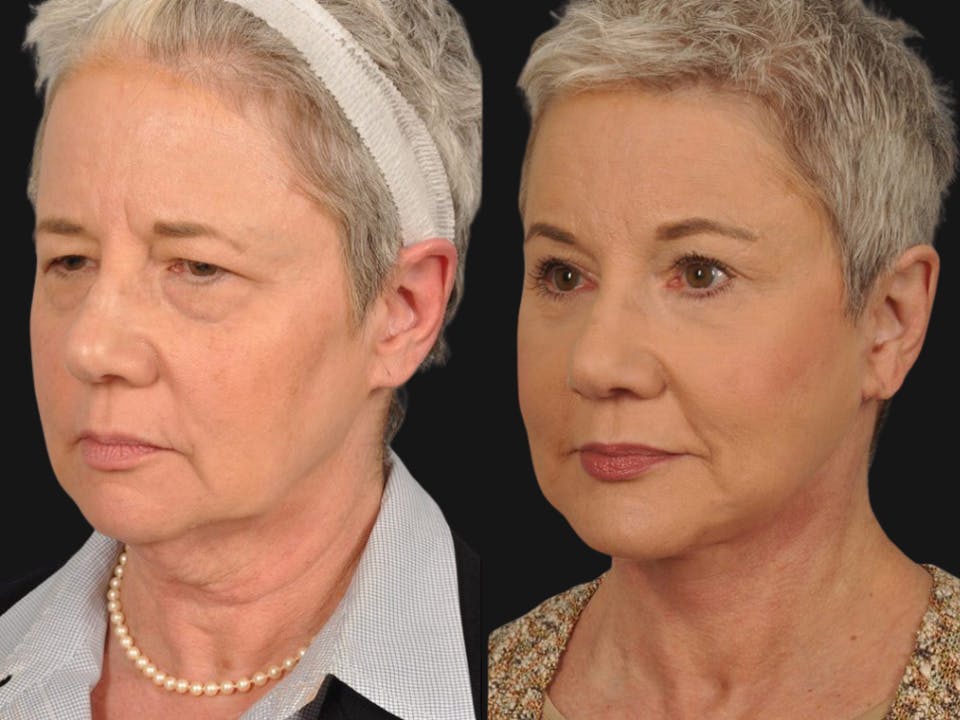 Mid Facelift Before & After Gallery - Patient 353250 - Image 2