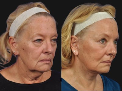 Mid Facelift Before & After Gallery - Patient 177242 - Image 2