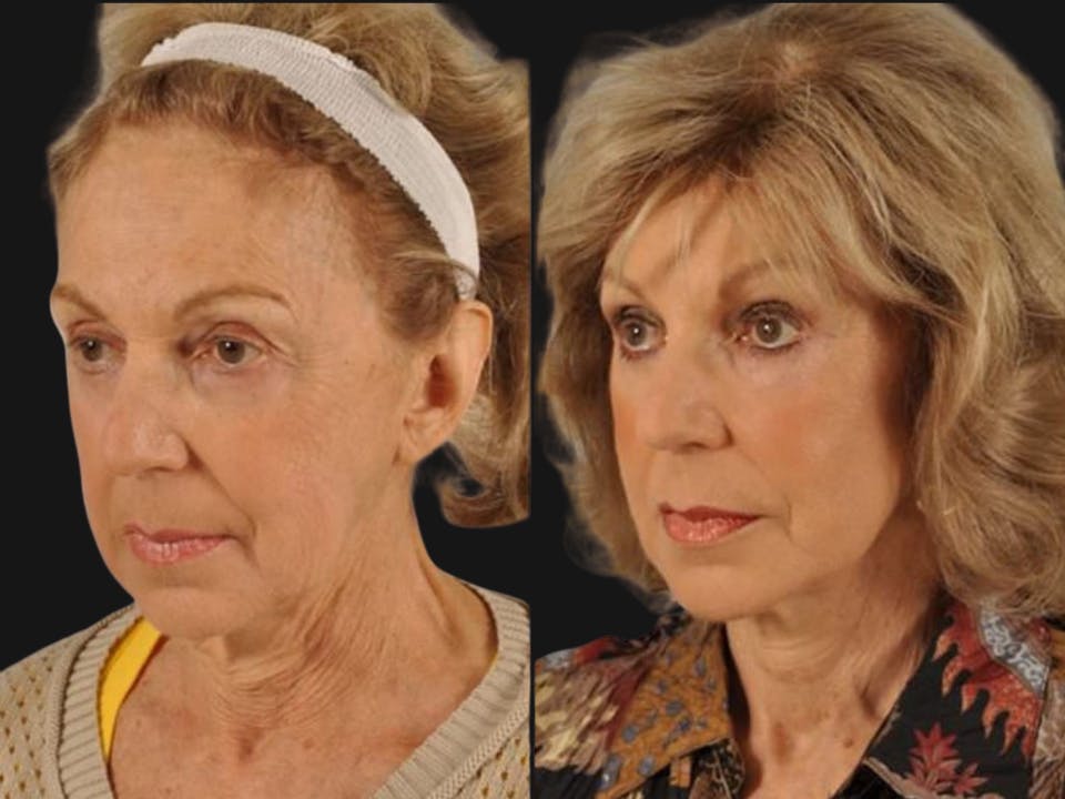 Mid Facelift Before & After Gallery - Patient 227892 - Image 3