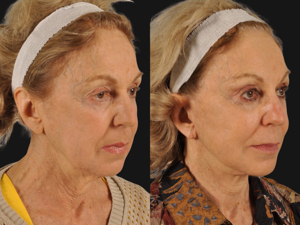 Mid Facelift Before & After Gallery - Patient 227892 - Image 2