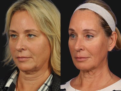 Mid Facelift Before & After Gallery - Patient 362985 - Image 2