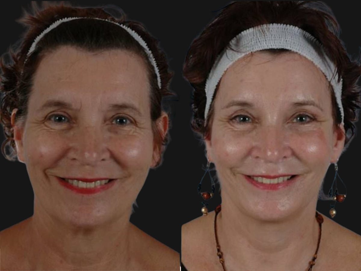 Mid Facelift Before & After Gallery - Patient 315340 - Image 2
