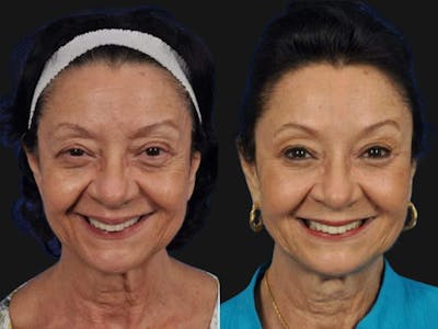 Mid Facelift Before & After Gallery - Patient 286431 - Image 2