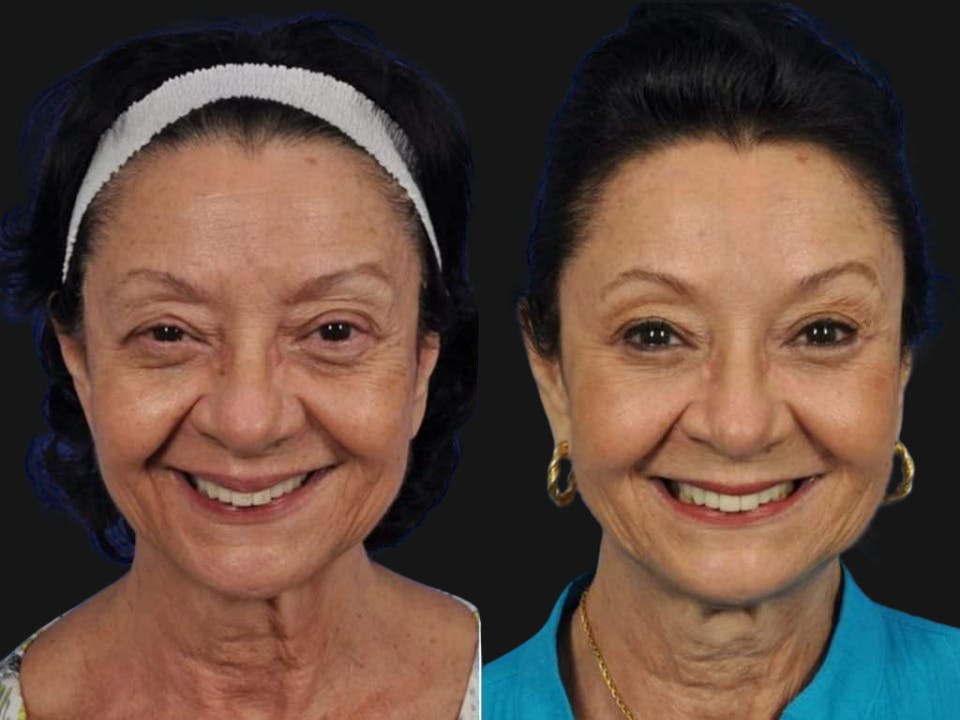 Mid Facelift Before & After Gallery - Patient 286431 - Image 2