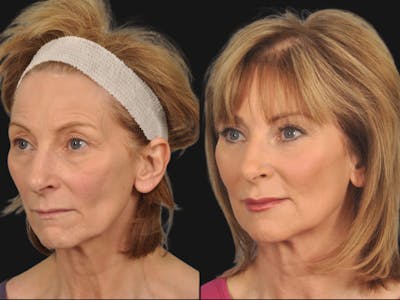 Mid Facelift Before & After Gallery - Patient 826650 - Image 2