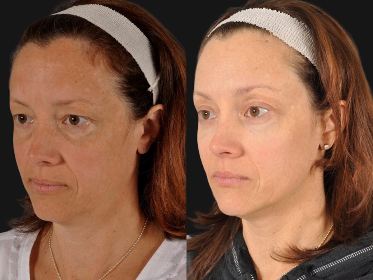 Mid Facelift Before & After Gallery - Patient 394554 - Image 2