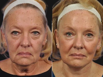 Mid Facelift Before & After Gallery - Patient 177242 - Image 1