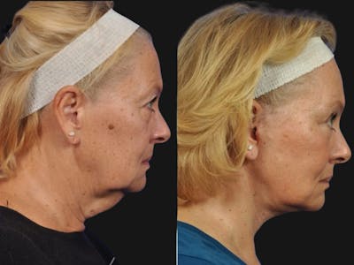 Mid Facelift Before & After Gallery - Patient 177242 - Image 3