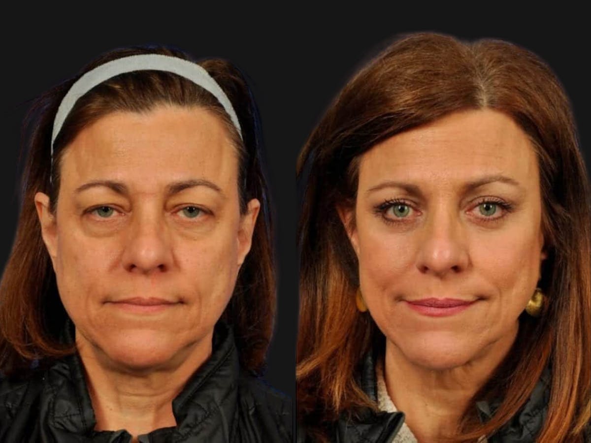 Mid Facelift Before & After Gallery - Patient 176857 - Image 1