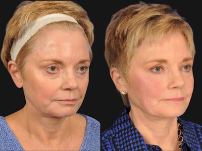 Mid Facelift Before & After Gallery - Patient 126803 - Image 3