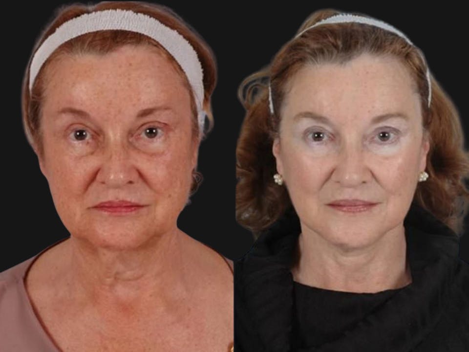 Mid Facelift Before & After Gallery - Patient 202388 - Image 1