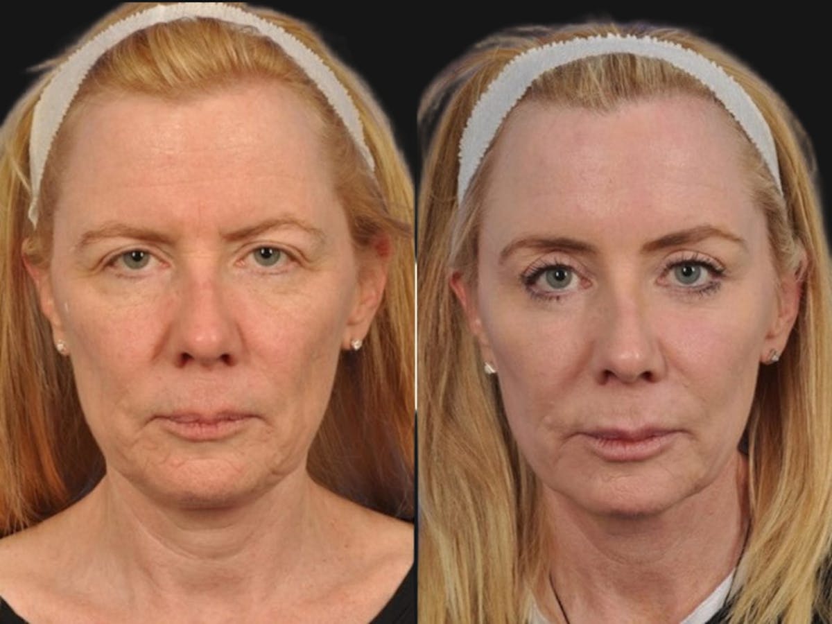 Mid Facelift Before & After Gallery - Patient 315338 - Image 1