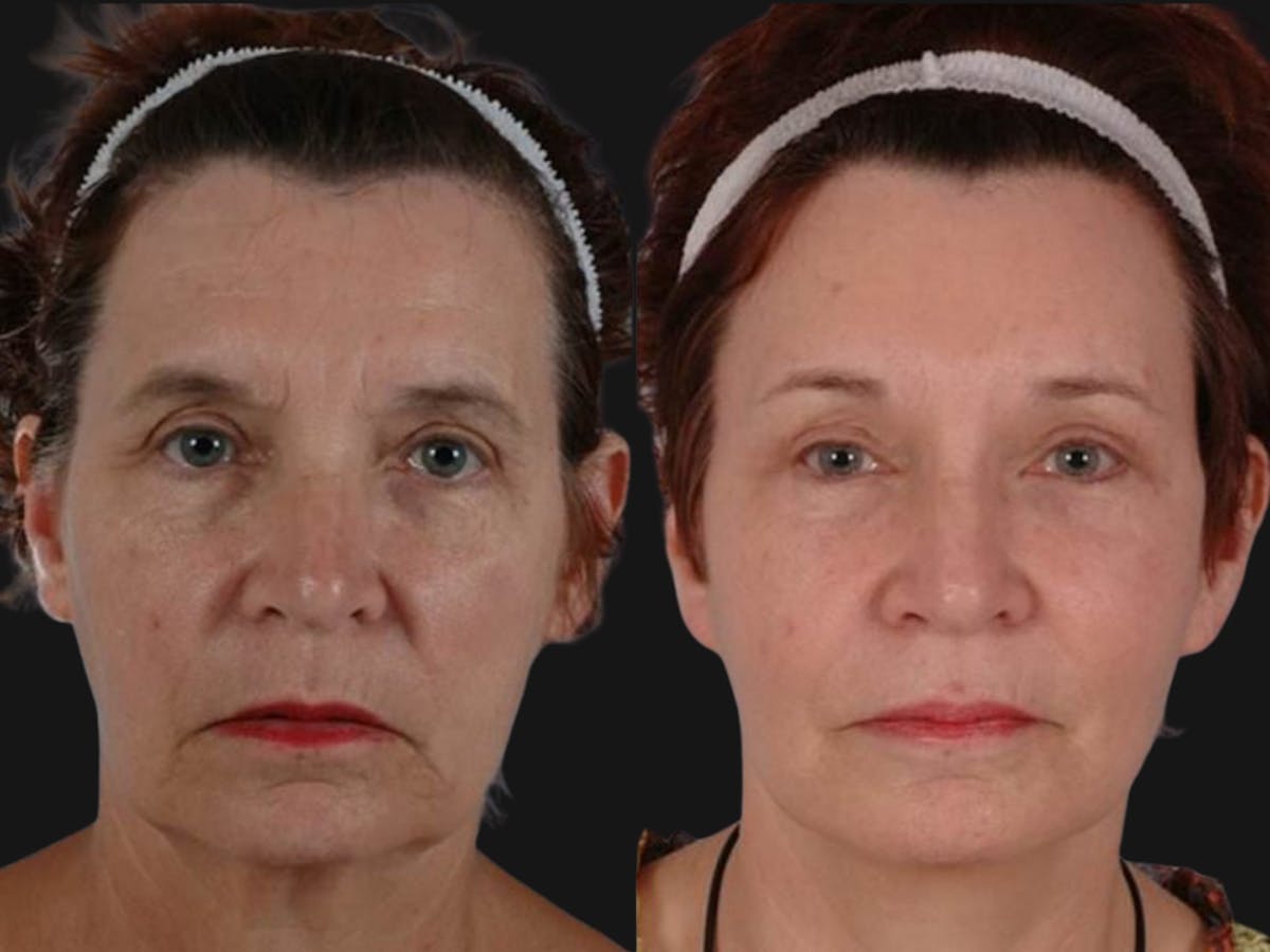 Mid Facelift Before & After Gallery - Patient 315340 - Image 1