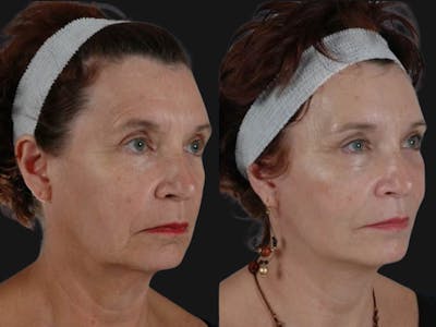 Mid Facelift Before & After Gallery - Patient 315340 - Image 3