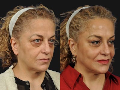 Mid Facelift Before & After Gallery - Patient 197781 - Image 3