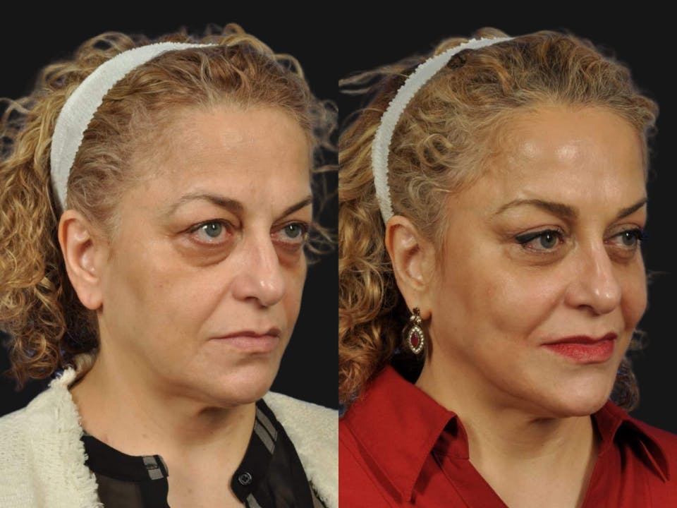 Mid Facelift Before & After Gallery - Patient 197781 - Image 3