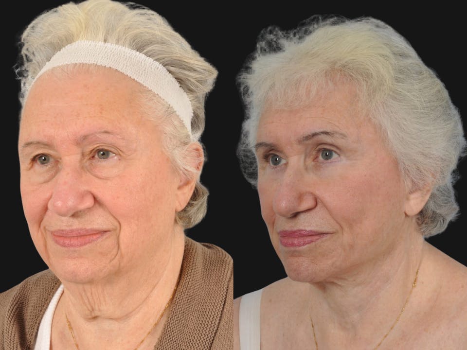 Mid Facelift Before & After Gallery - Patient 654797 - Image 4