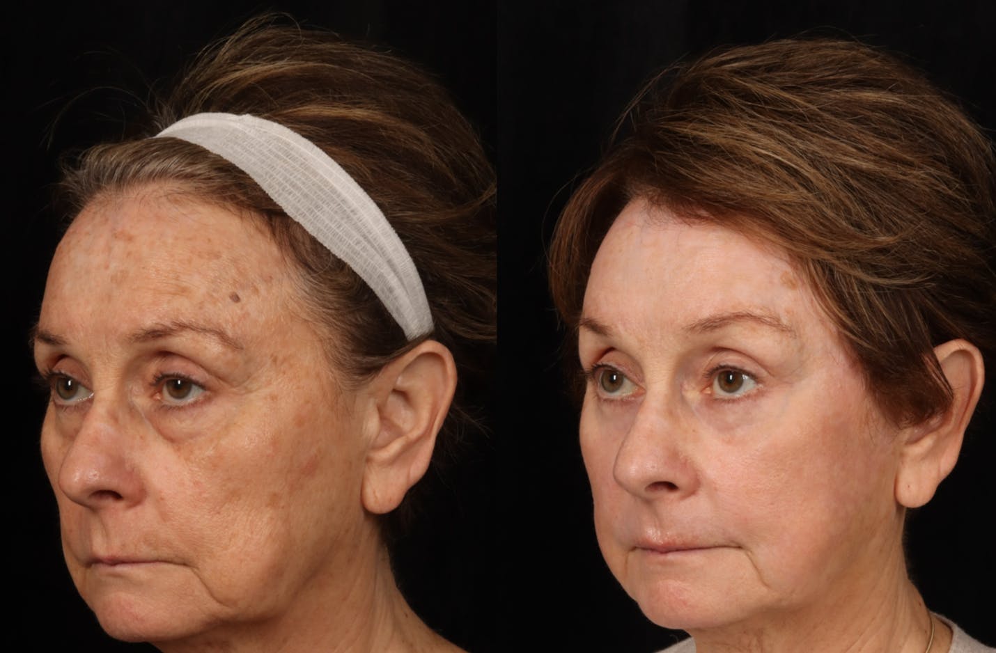Mid Facelift Before & After Gallery - Patient 389020 - Image 2