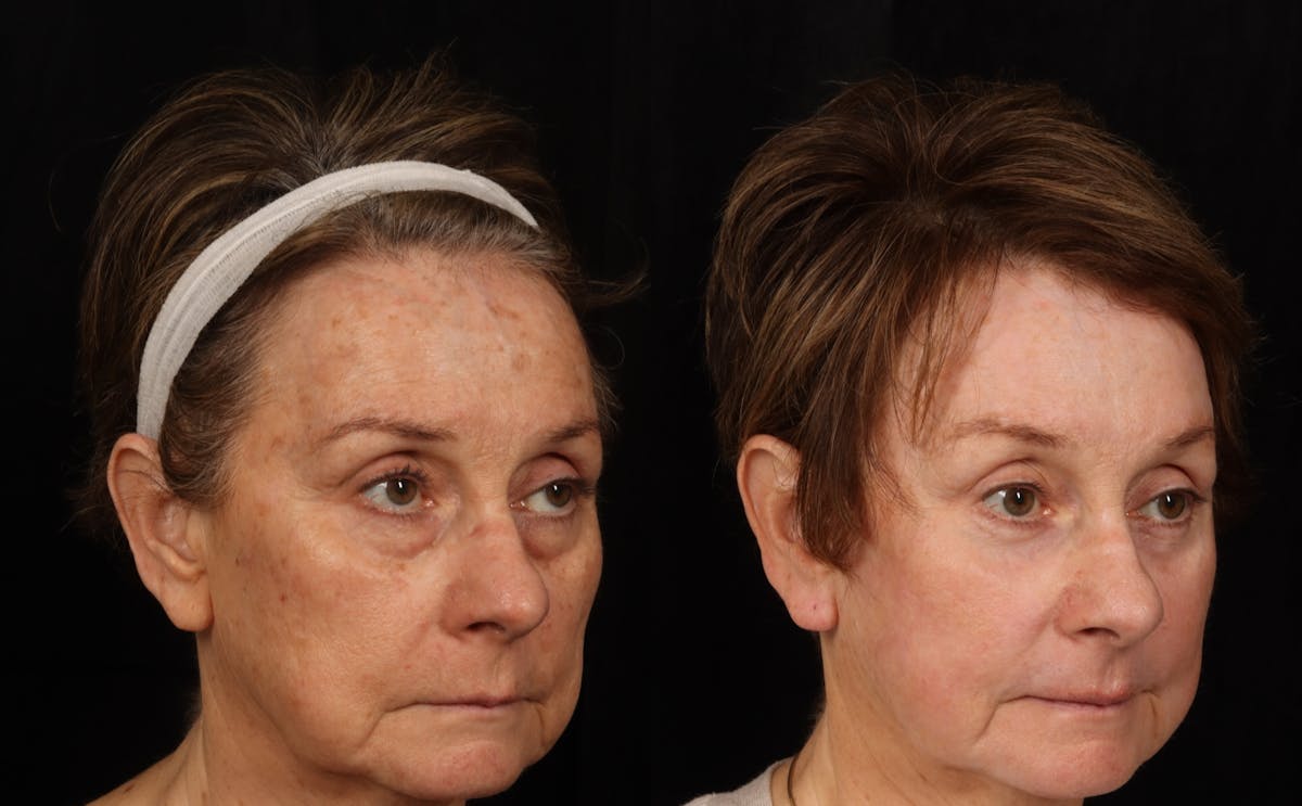 Mid Facelift Before & After Gallery - Patient 389020 - Image 3