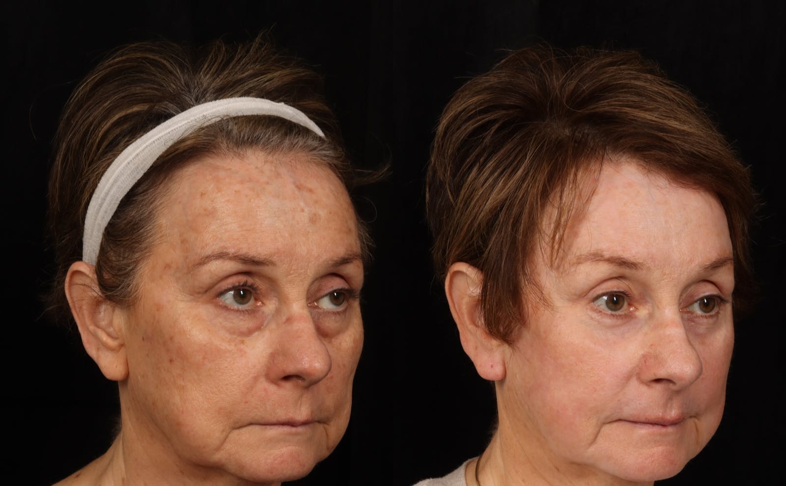 Mid Facelift Before & After Gallery - Patient 389020 - Image 3