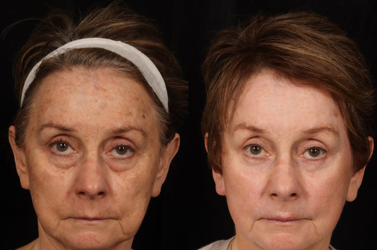 Brow Lift Before & After Gallery - Patient 819918 - Image 1