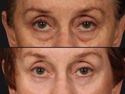 Blepharoplasty Before & After Gallery - Patient 356811 - Image 2