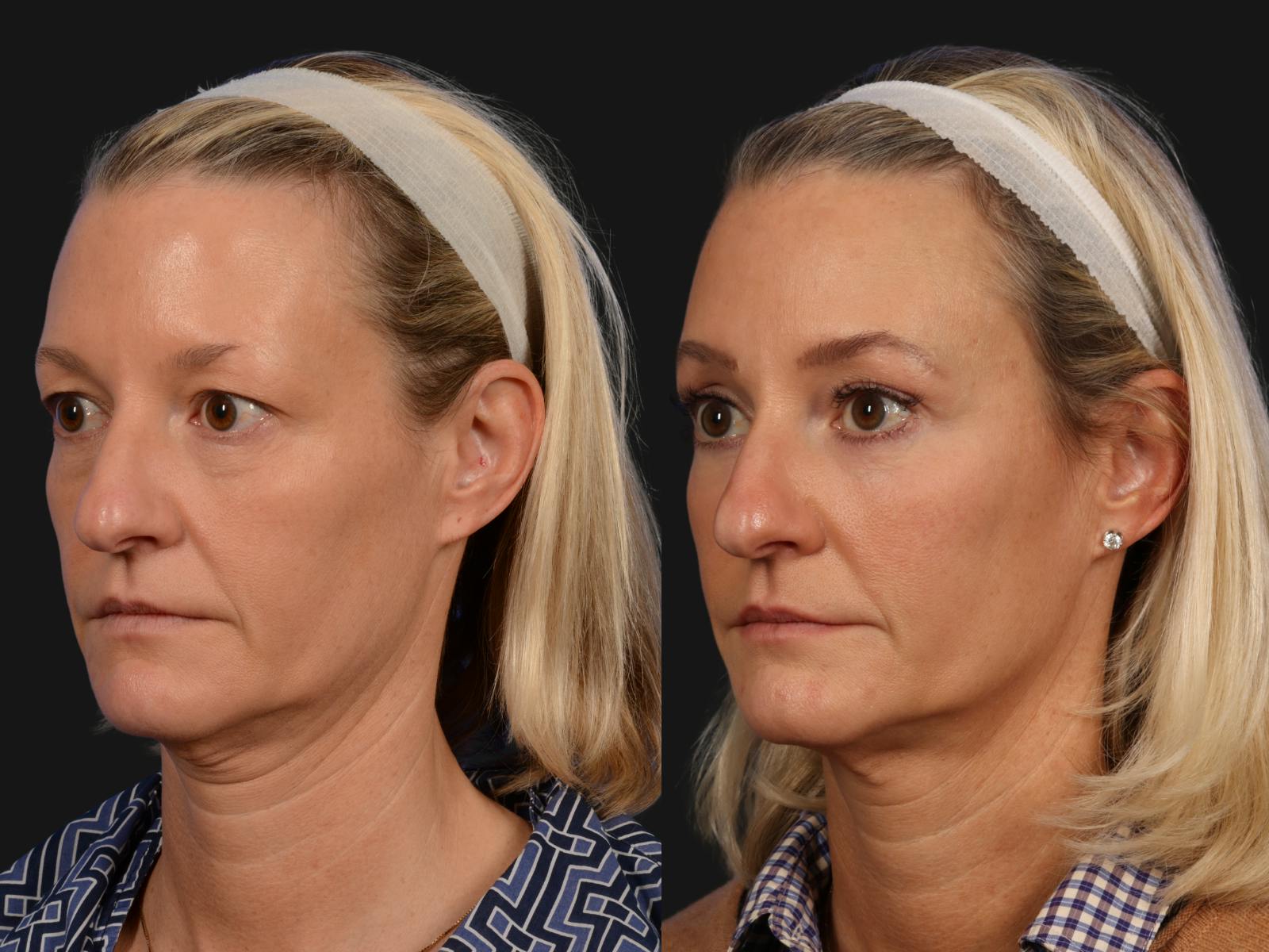 Mid Facelift Before & After Gallery - Patient 332380 - Image 3