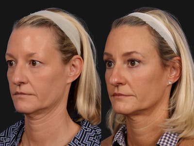 Mid Facelift Before & After Gallery - Patient 332380 - Image 3