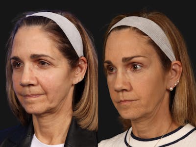 Mid Facelift Before & After Gallery - Patient 321454 - Image 3