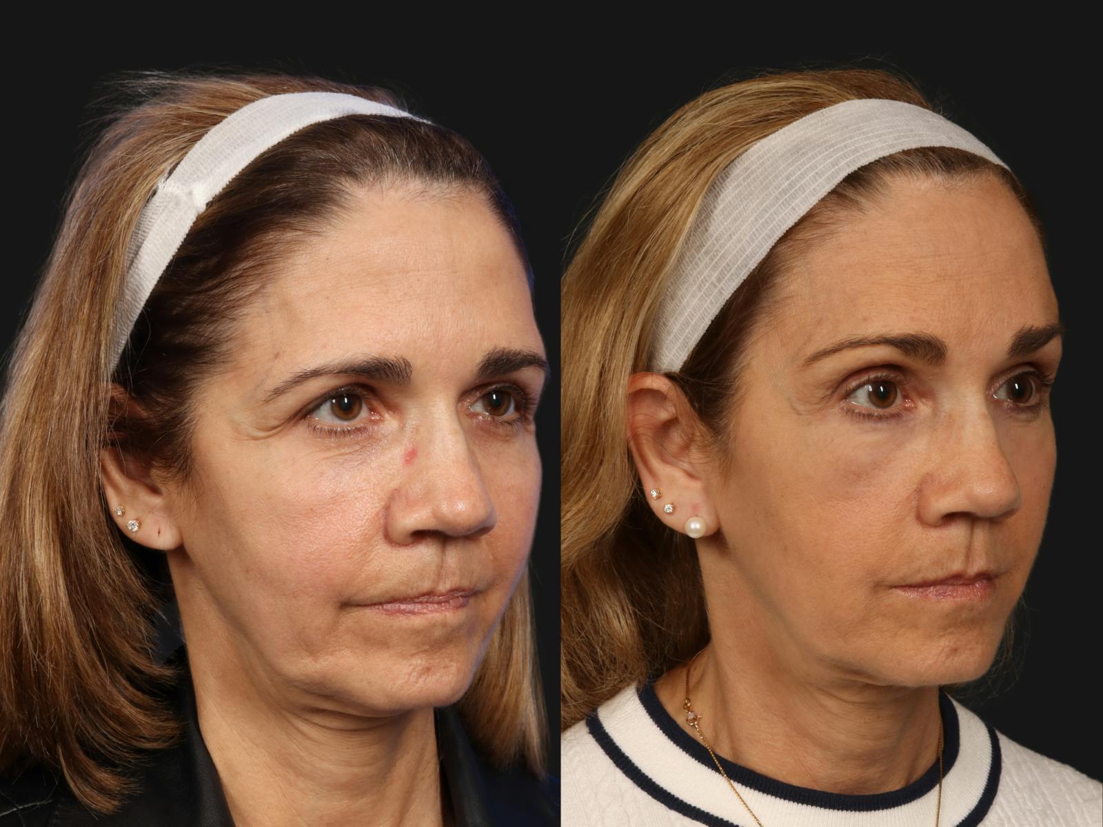 Mid Facelift Before & After Gallery - Patient 321454 - Image 2