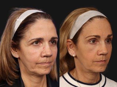 Mid Facelift Before & After Gallery - Patient 321454 - Image 2