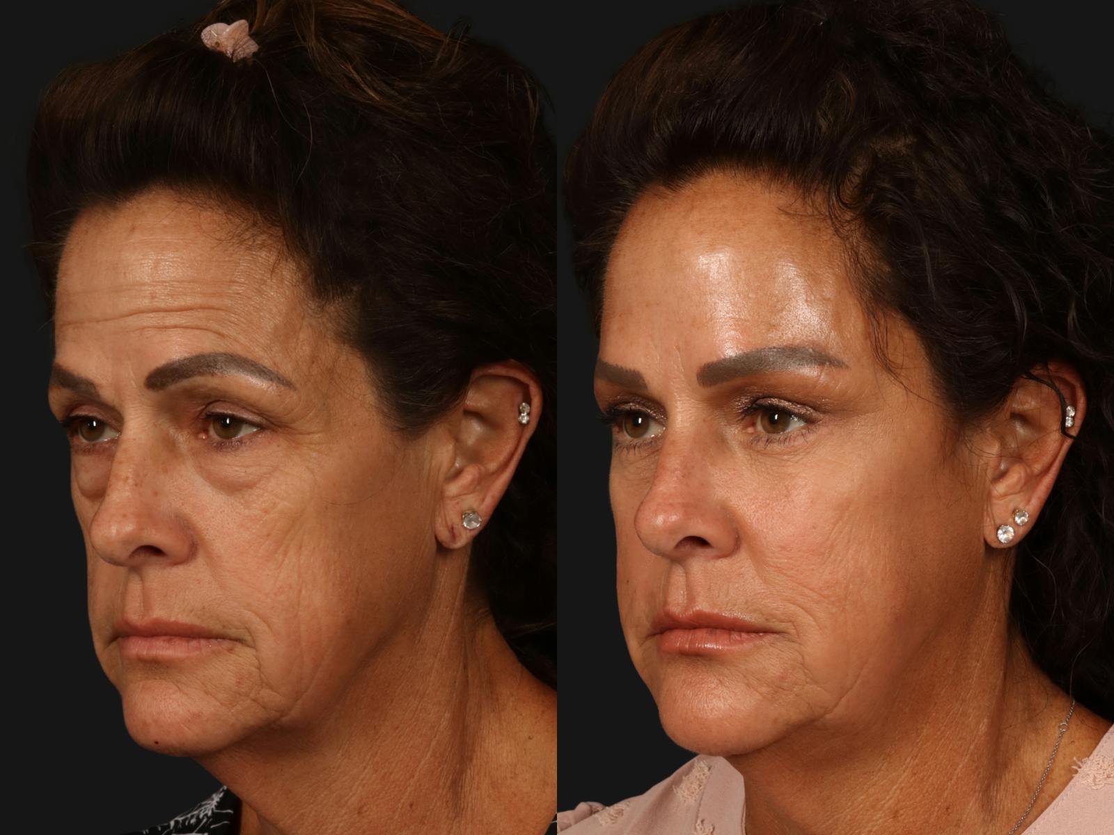 Mid Facelift Before & After Gallery - Patient 130175 - Image 3