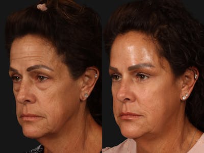 Mid Facelift Before & After Gallery - Patient 130175 - Image 3
