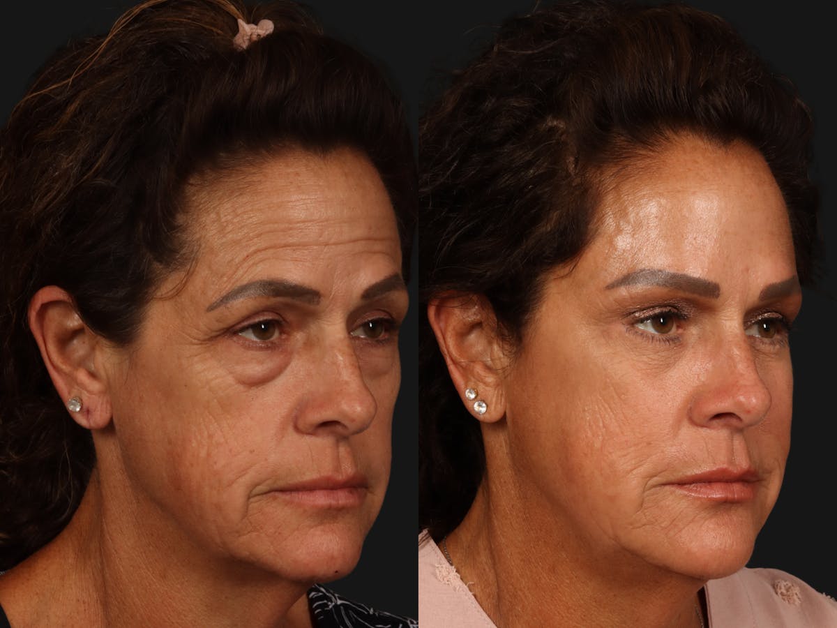 Mid Facelift Before & After Gallery - Patient 130175 - Image 2