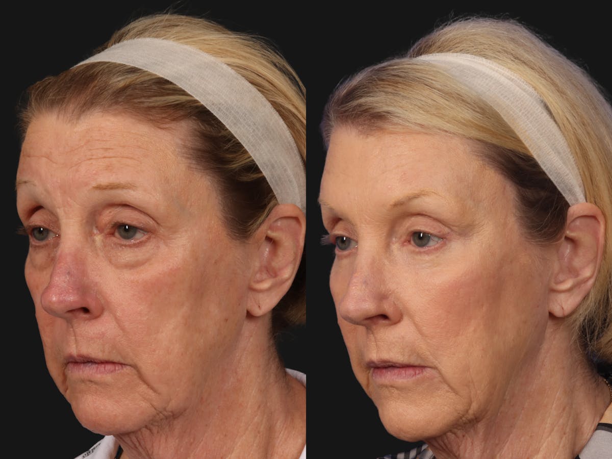 Mid Facelift Before & After Gallery - Patient 365785 - Image 2