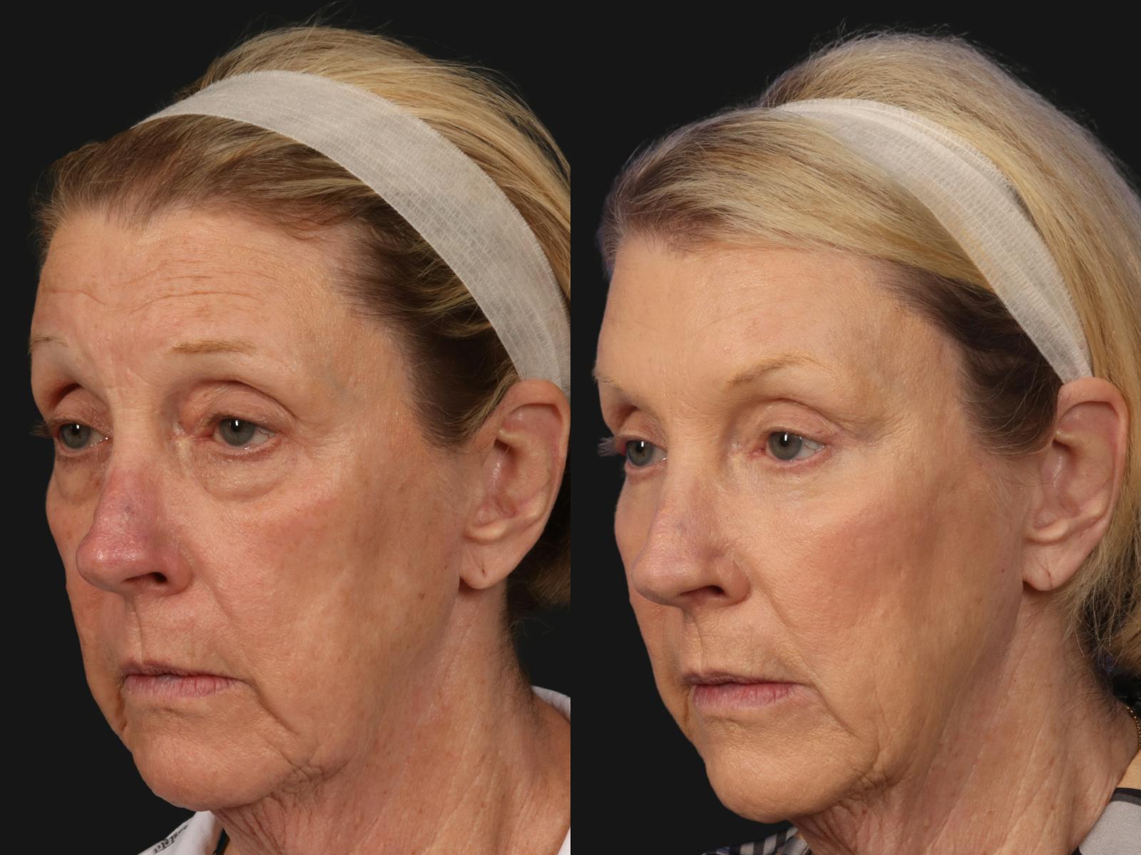 Mid Facelift Before & After Gallery - Patient 365785 - Image 2