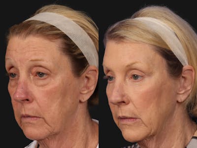 Mid Facelift Before & After Gallery - Patient 365785 - Image 2